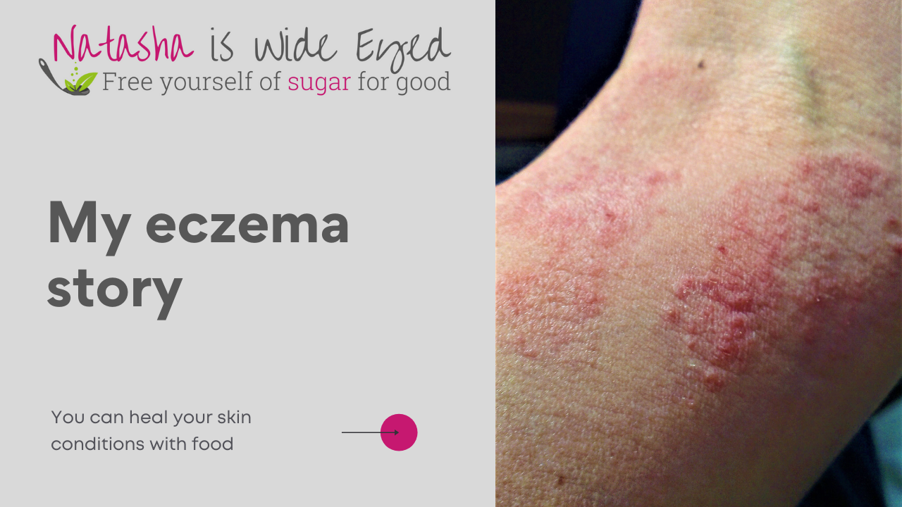 title showing My eczema story and a picture of a previous bad flare up on my arm